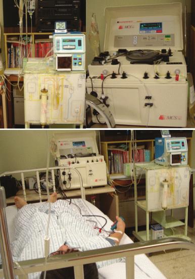 - 대한내과학회지 : 제 74 권부록 1 호 2008 - 음파에서국소벽운동장애는소실되었다. 성분채집술시행방법 : Plasmapheresis 는 MCS 3p (Haemonetics Corp., Braintree, USA) 또는 Cobe Spectra (Cobe BCT Inc.