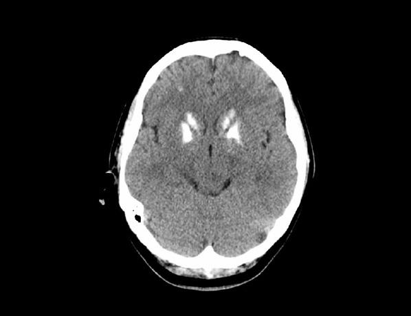 대한내분비학회지 : 제 24 권제 2 호 2009 Fig. 3. Brain CT image.