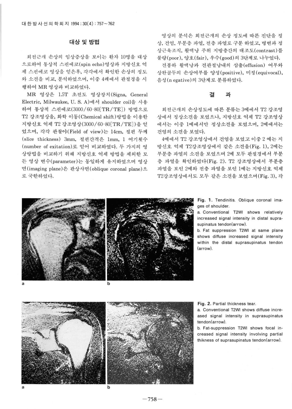 대한방사선의학회지 1994 ; 30(4): 757-762 대상및방법회전근개손상의임상증상을보이는환자 10명을대상으로하여통상적스펀에코 (spin echo) 영상과지방신호억제스핀에코영상을얻은후, 각각에서확인한손상의정도와소견을비교, 분석하였으며, 이중 4 례에서관절경을시행하여 MR 영상과비교하였다. MR 영상은 1.