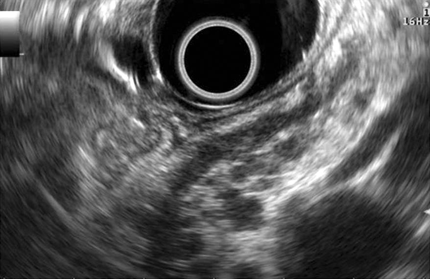 Histological findings of the specimens obtained by fine needle aspiration via endoscopic ultrasonography.