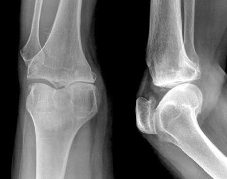 499 Mid-Term Results of Fixed Bearing Unicompartmental Knee Arthroplasty 다는이론적인장점이있지만움직임이많은특성으로인해유동성삽입물의탈구가생길수있으며이러한탈구를줄이기위해수술시두꺼운경골삽입물을사용하게되면과교정으로인해외측구획의관절염이빠르게진행하는합병증이있을수있다고알려져있다.