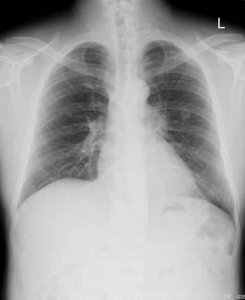 - Chang Seok Bang, et al. Primary malignant melanoma of the lung: a case report - 성폐악성흑색종환자에서고식적인치료를통해 5년이상의장기생존을보인증례를경험하였기에보고하는바이다. 증 례 Figure 1. The chest X-ray shows a solitary pulmonary nodule (1.