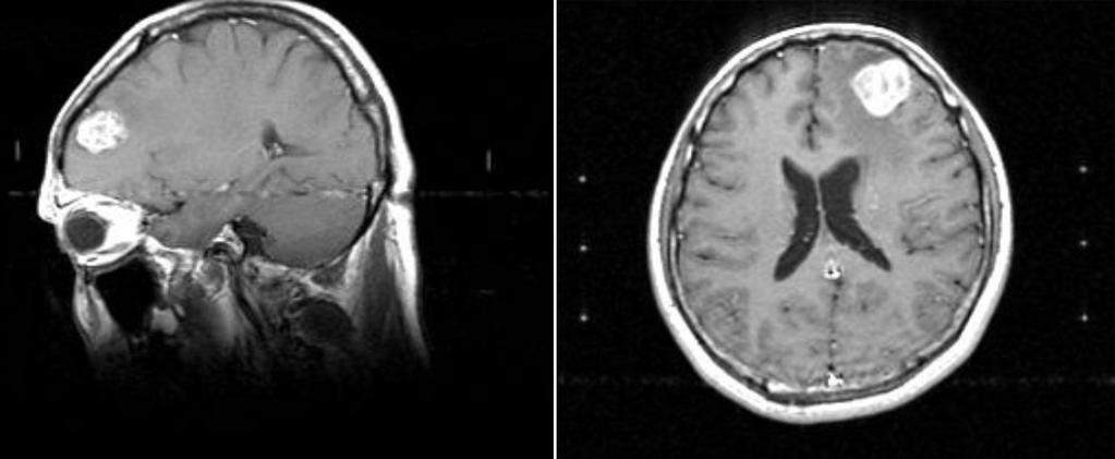 - 방창석외 6 인. 원발성폐악성흑색종의진단과치료 1 예 - A B Figure 4. Brain magnetic resonance imaging shows a well-enhanced left frontal lobe mass surrounded by a low signal edematous lesion. 이발견되었다 ( 그림 4).