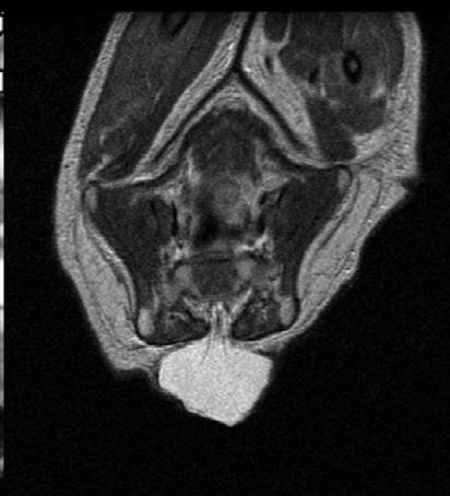 neuropore Anencephaly 12 26 Closure of caudal neuropore Myelomeningocele