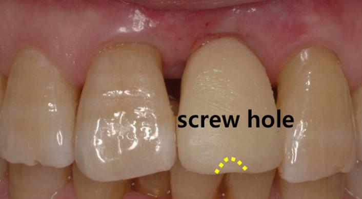of screw hole, (D) First provisional restoration.