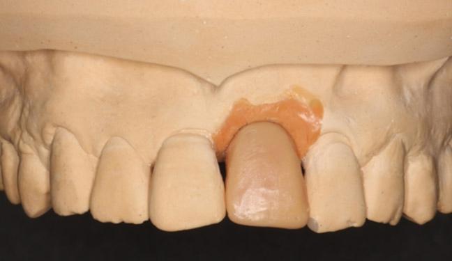 2 패턴레진 (Duralay, Dental Mfg. Co. Worth, IL, USA) 을이용한맞춤형인상코핑을제작하여최종인상채득에이용하였다 (Fig. 6A, Fig. 6B, Fig. 6C).