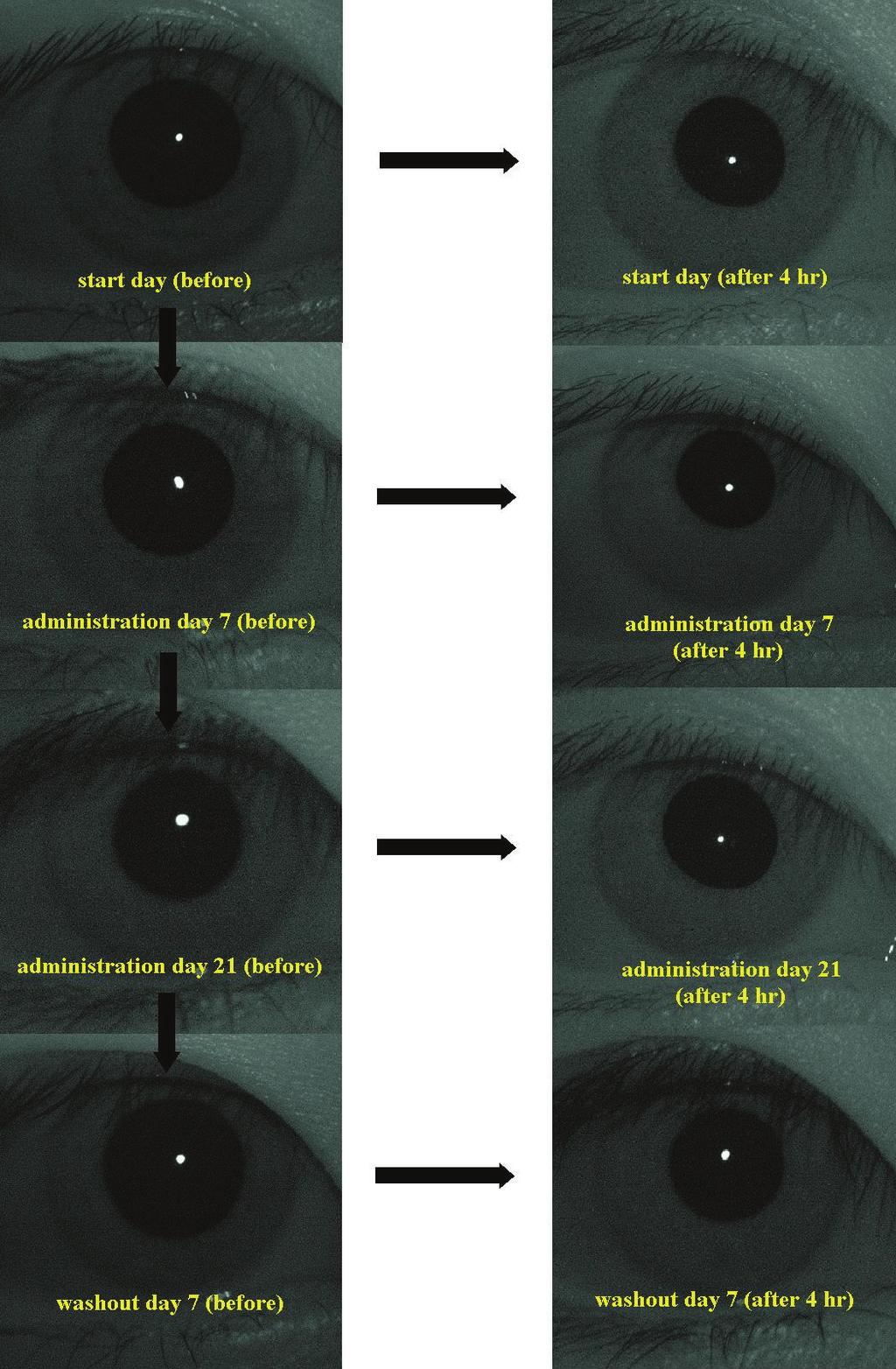 대한안과학회지 2008 년제 49 권제 10 호 Figure 1. The effect of brimonidine tartrate 0.15% on the pupil size under scotopic condition. Infrared digital photography was taken under scotopic condition (less than 0.