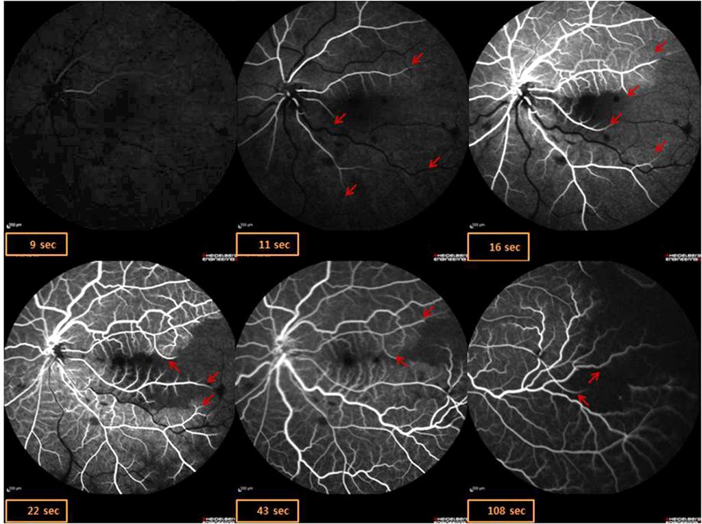 shaped retinal hemorrhages are seen in the left eye (). C D E F Figure 2. Fluorescent angiography of the left eye after ocular massage.