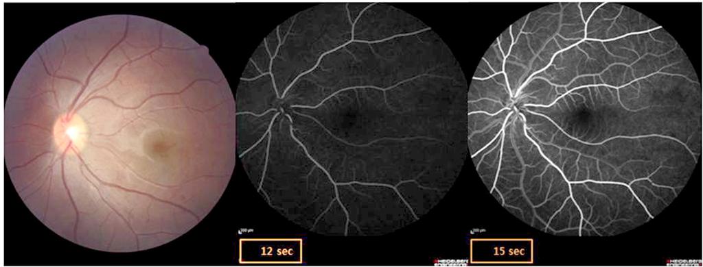 - 대한안과학회지 2014년 제 55 권 제 2 호 - Figure 3. Color fundus photography and fluorescent angiography of the left eye 3 weeks after treatment. rterial filling and arteriovenous transit time is normal.