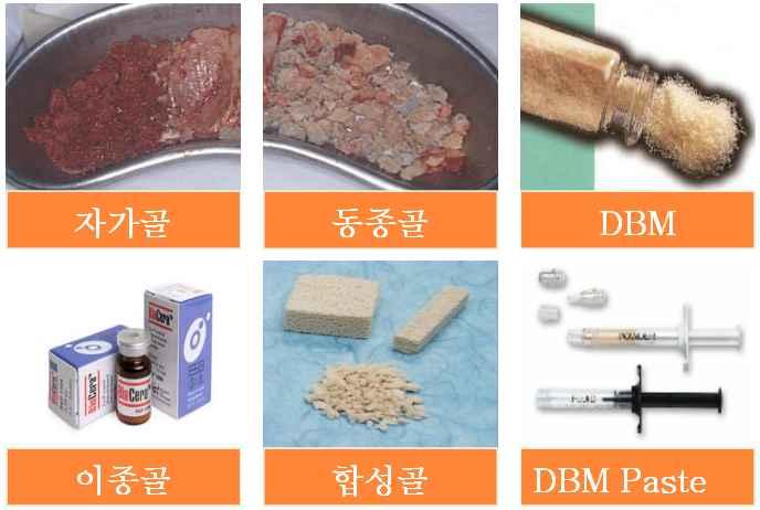 기존제품의문제점 o 기존의골이식재로는기증한사람의시신에서채취하여가공, 소독, 멸균한동종골이식재, 이를탈회처리한 DBM 및 DBM