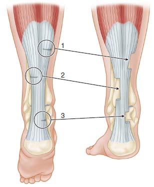 hamstring의약화를가져올위험이있음 무릎관절에대한수술