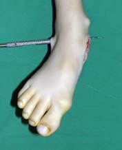 activity during swing Foot and Ankle Equinovalgus Calcaneal neck lengthening osteotomy Pathologic flafoot Talonavicular subluxation