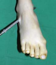 + overpull of peroneus Pain, callus, ulceration under the plantar flexed head of the talus, with poor brace tolerance Valgus may come