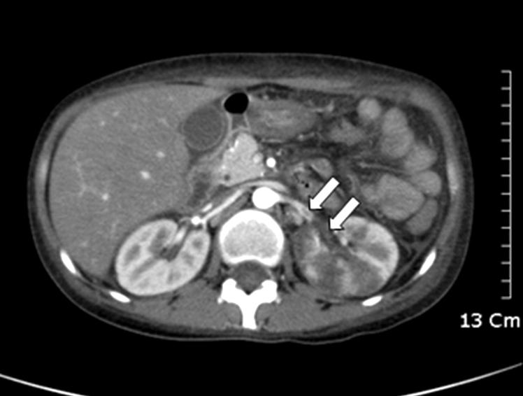 대한류마티스학회지 제 16 권 제 3 호 2009 Fig. 1. 27-year-old woman with multiple left renal infarctions.