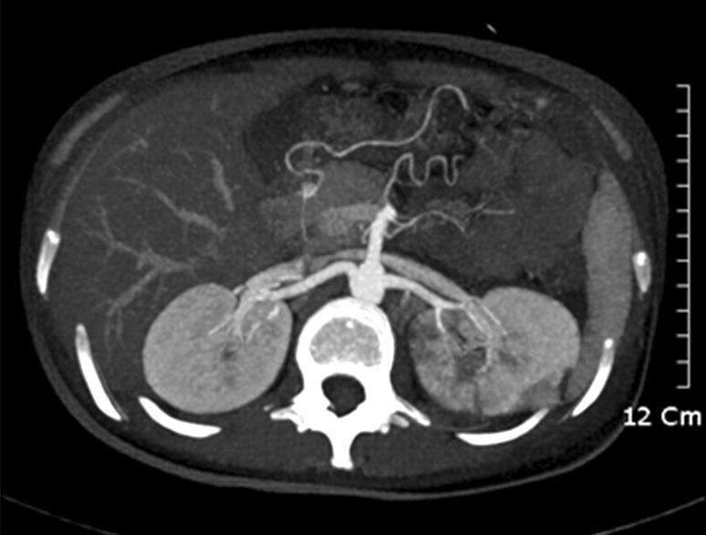 Multiple filling defects (arrows) in left main and segmental renal arteries suggest the thromboembolism.