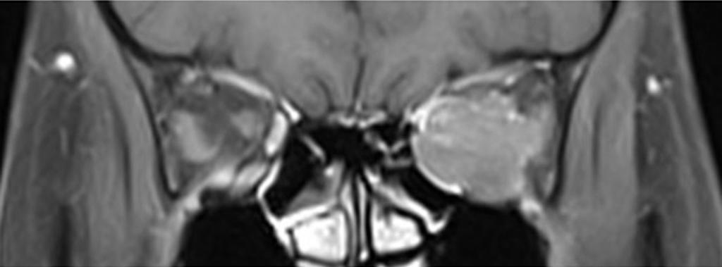 6개월, 범위 4-60개월 ) 중 12명에서는최종추적관찰시종양의크기가증가하는 A B C Figure 2. Magnetic resonance imaging of the metastatic orbital tumor from thymic origin neuroendocrine.