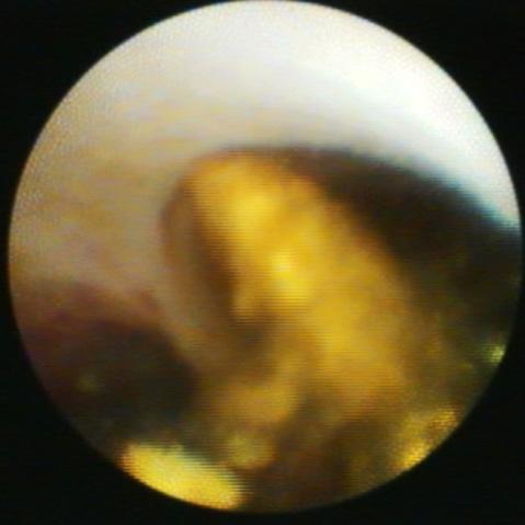 (C E) Yellowish bile sludge continuosly came out from the cystic duct.