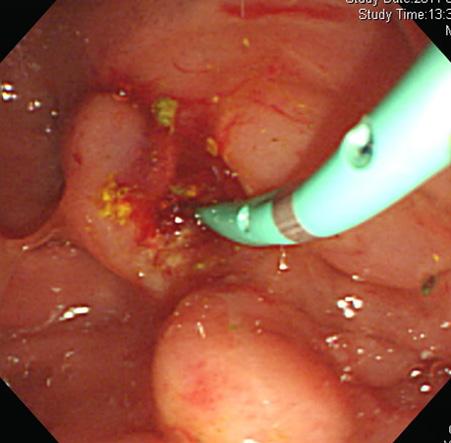 스파이글래스담도내시경을이용한내시경적경비담낭배액술 143 Fig. 5. Endoscopic naso-gallbladder drainage inserted under the visual guidance of Spyglass cholangioscopy. (A) A guide wire was inserted into the cystic duct.