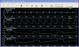 ㆍ심혈관계모니터링ㆍ뇌전도모니터링ㆍ백터 ECG 모니터링ㆍ근전도와근수축력분석 상기그림은측정화면의일부이며, P400