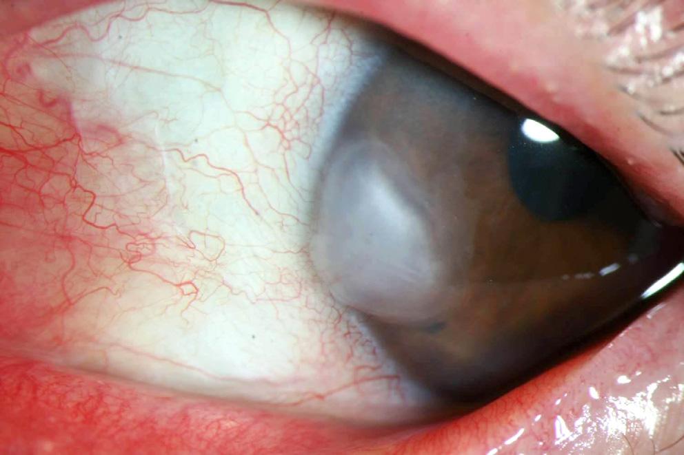 () Recurrent corneal mass on the same site.