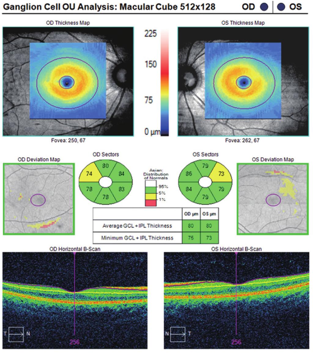 (B) Macular ganglion cell analysis map.