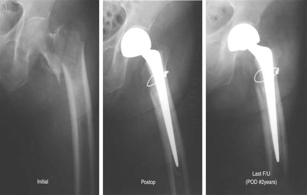 (kelley Grade A) (C) Post operative 2 years radiograph shows stable fixation. A B C Fig. 2. (A) Preoperative radiograph of a 81 years old male shows comminuted intertrochanter fracture.