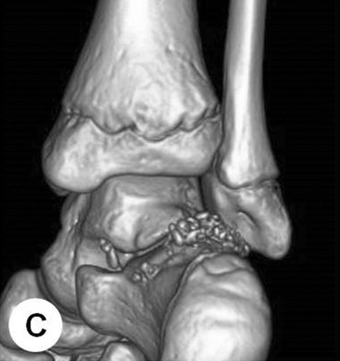 (A) Anteroposterior view showed radio-opaque area near the