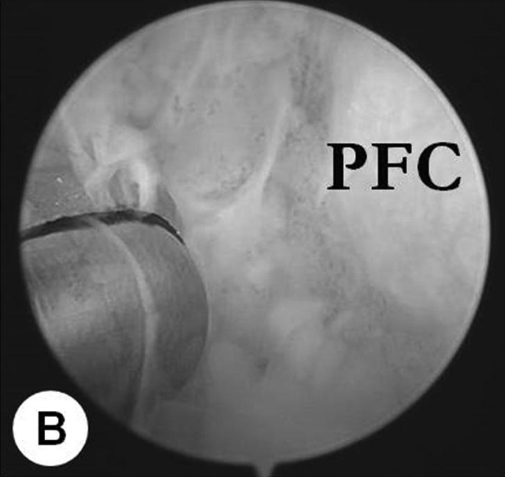 (A) Multiple cartilaginous loose bodies (asterisks) and minimal synovial proliferation were shown around talocalcaneal