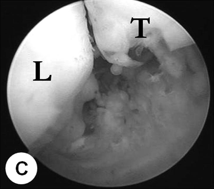 Yellowish nodular cartilaginous metaplasia and accompanying loose bodies were shown in (C) lateral and (D) medial gutters of