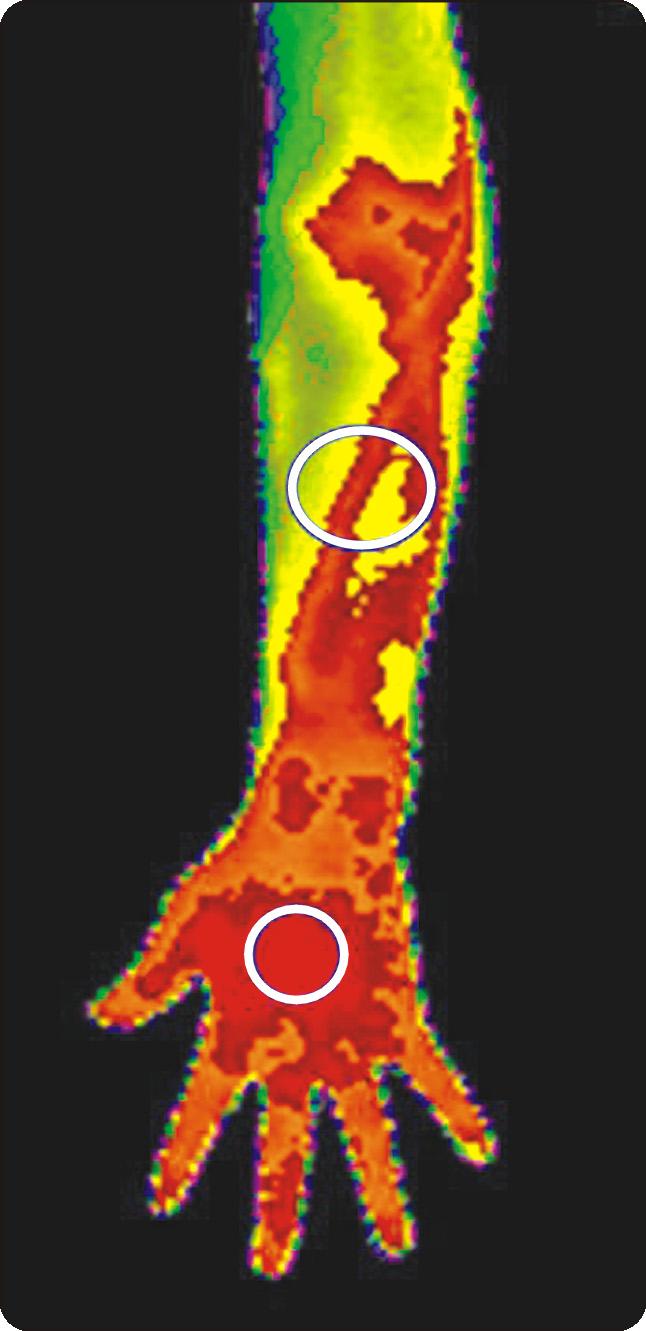 Ho-Yeol Zhang: Carpal Tunnel Syndrome: Correlation between Thermal Differences and Severity in EMG Study 대상및방법 2005년부터 2007년까지수술한 6명의환자 12개의손목을대상으로하였다. 이들모두는수술전근전도검사를시행하였고, 체열촬영은 4명에서시행하였다.