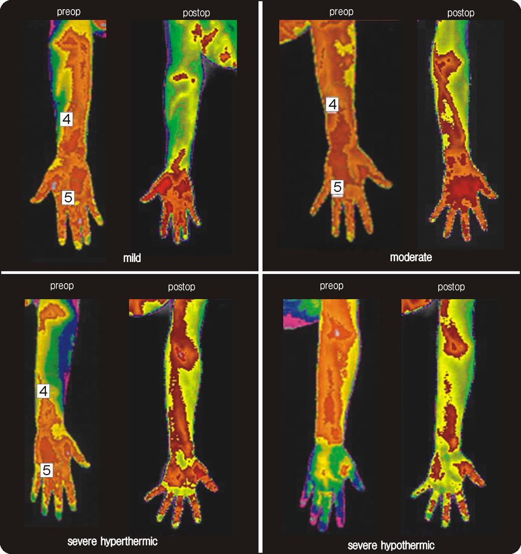 Ho-Yeol Zhang: Carpal Tunnel Syndrome: Correlation between Thermal Differences and Severity in EMG Study Fig. 3.