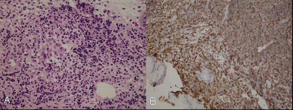 JH Cho et al. : The treatment of massive spontaneous subcutaneous emphysema by multiple intravenous catheter Figure 5.