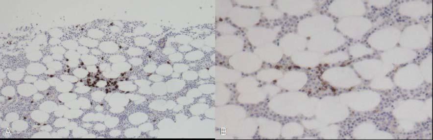 Tuberculosis and Respiratory Diseases Vol. 61. No.2, Aug. 2006 월후다시시행한위내시경에서병변은호전되었고흰색반흔이남아있었으나조직검사에서는여전히 MALT림프종이남아있었다.