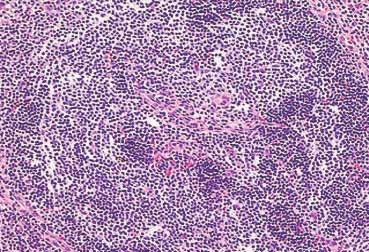They show small to medium-sized, monocytoid, atypical, marginal zone B-cells. (C) IgD immunostain reactivity of tumor cells. 막주위로종양세포의침윤이관찰되었다.
