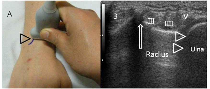 Fig 1. Ultrasound examination of distal radioulnar joint (A)Wrist and hand position for ultrasound examination of distal radioulnar joint (arrow head:ulnar head).