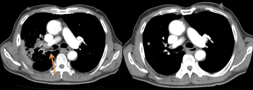 - The Korean Journal of Medicine: Vol. 87, No. 5, 2014 - Figure 1. Chest computed tomography scan shows multiple lymphadenopathy in the left axilla. A B Figure 2.