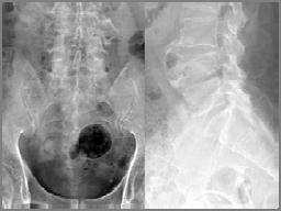 (X-ray) 퇴행성변화 (Spondylosis) 1) 척추의정렬및구조 (Alignment 1 Spur formation and