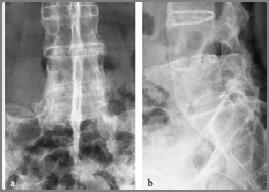 운동범위의제한다른관절이환 : 손가락, 견관절, 고관절 Inflammatory spondyloarthropathy Ankylosing Spondylitis 전형적인요통의패턴 종양밤에잘때 (Night Pain), 휴식시통증다른전신증상 : 체중감소암의병력 전형적인요통의패턴 감염밤과휴식시악화발열, 오한결핵 :