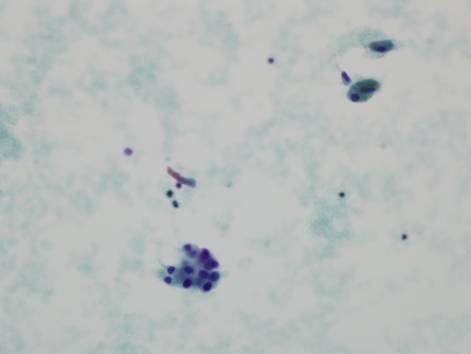 - 강미자외 6 인. 아급성갑상선염이동반된갑상선자율기능성결절 - C Figure 5. Fine needle aspiration cytology and cell block of a left thyroid nodule.