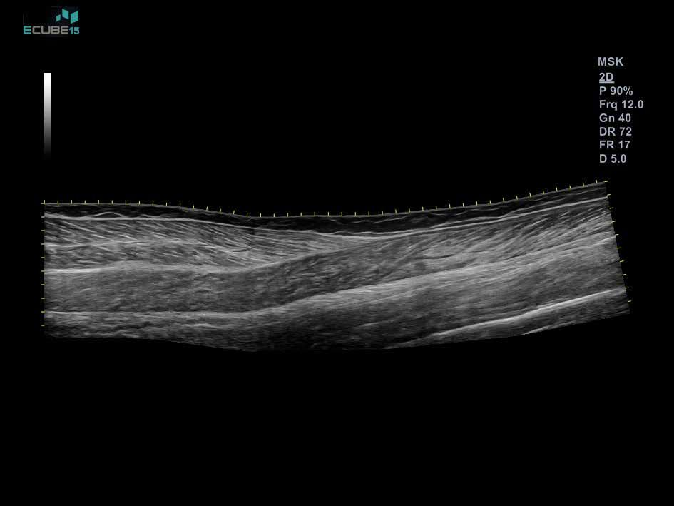 Tendon at the MCP joint image with IO8-17 displaying