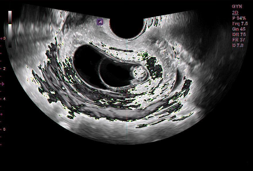 Elastography map showing the gradations of stiffness