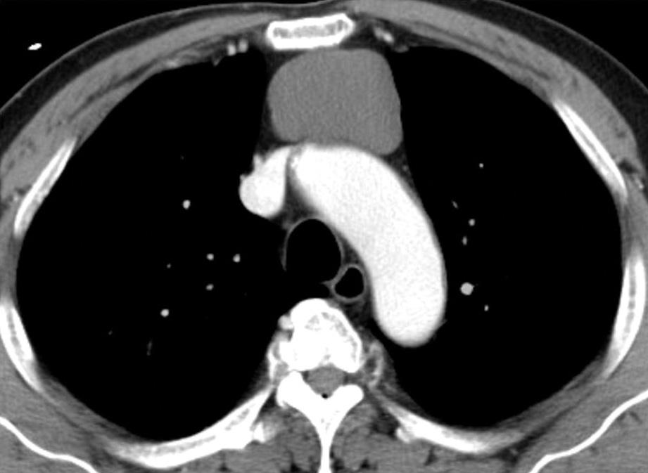 Thymic cyst in a 76-year-old asymptomatic man. Contrast enhanced CT scan shows a thin-walled water attenuation cyst in anterior mediastinum. 동낭성종양과감별하기어려웠다.