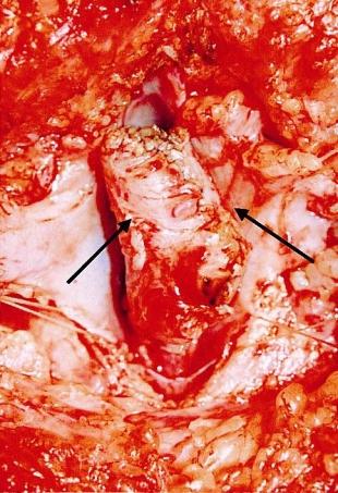 남은 조직의 연막(pia)을 봉합하여 원추척수(conus) 서 걷고 뛸 수 있었다(ase 2). 수술 전 근전도 검사를 시행 형태를 만들어 주었다(Fig. 4). 경막을 봉합한 후 배측의 근 하지 않았던 환자 중 1예는 비교적 수술 전 정상적인 운동기 육과 피하조직 및 피부를 성형하여 봉합하였다.