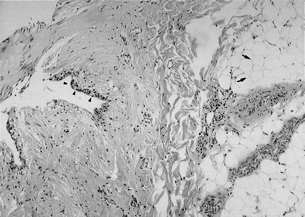 S spinal cord, D dura, E internal surface of myelocystocele(ependymal lining layer), O opening of central canal(arrow).