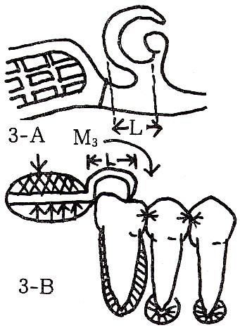 Case 2 : Distal connection 과근심레스트를갖는 back-action 클래스프 이경우는그림 3-B 의힘의개략도에보인것처 이경우는클래스프가 metal mesh frame 에직결되어의치상하방치은, 클래스프및근심레스트에서제2소구치에작용하는하중을지지하는상태이다.