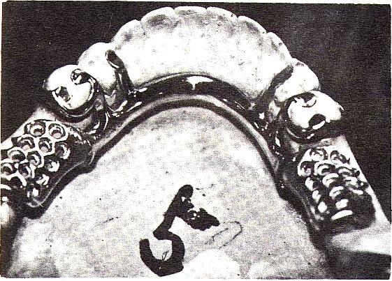 Mesial connection and distal rest Case 2. Distal connection and mesial rest Case 3.