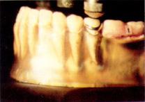 partial denture with the mesial connection and the distal