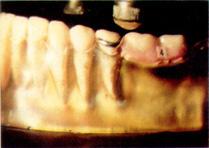 connection and mesial rest(unloaded side) Fig. 12.