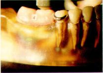 connection and the mesial and distal rest(loaded side) IV. 총괄및고안 Fig. 15.