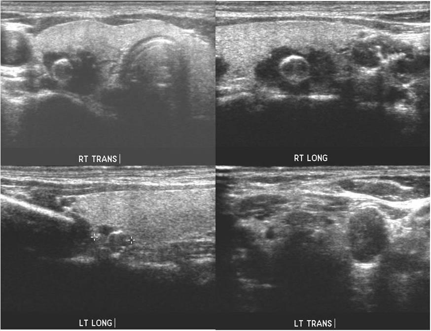 lesion. Fig. 3. Neck ultrasonography: dense calcified or non-calcified rim lesions, suspicious of parathyroid gland.